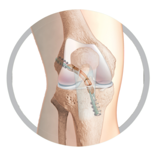 TLS Short Graft ACL reconstruction