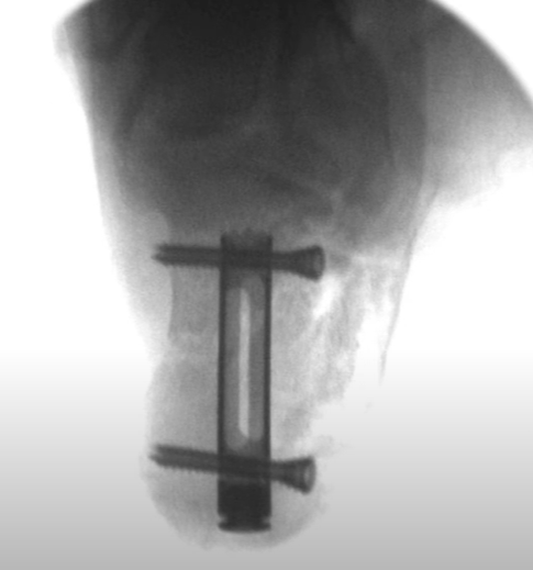 Post-op view of calcaneal fracture management with Calcanail