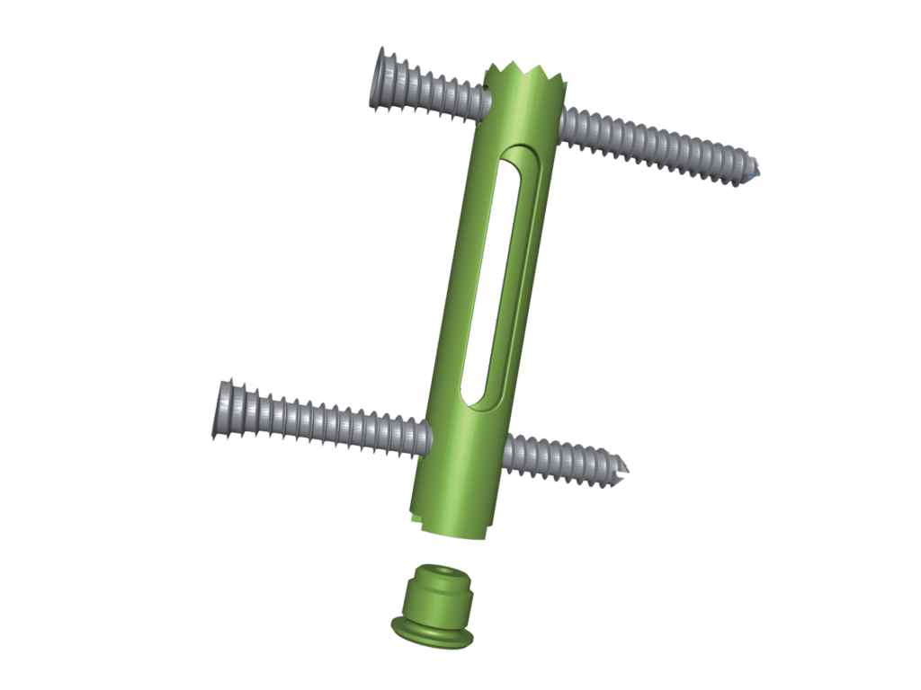 Calcanail implant