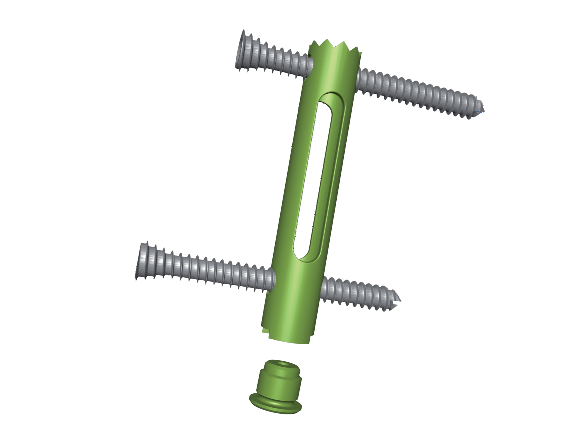 Calcanail implant