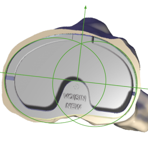 Personalised Implant Design